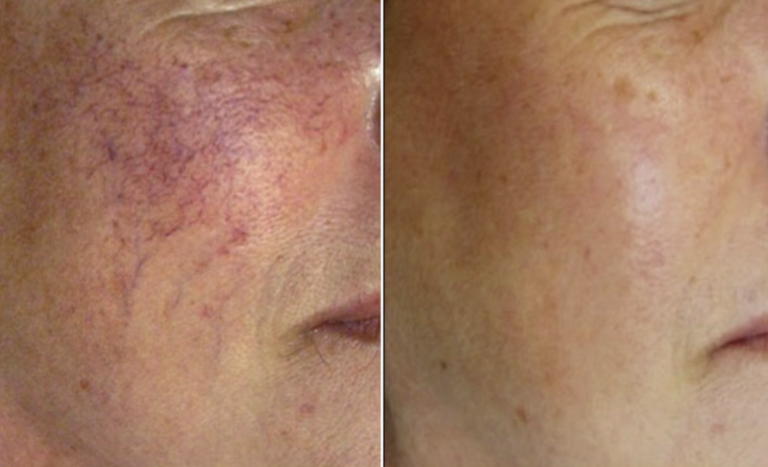 Lamprobe Treatments in Oakland County MI | FACE Beauty Science