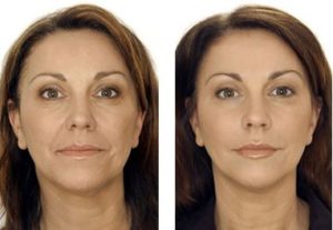 Liquid Facelift Treatments in Oakland County MI | FACE Beauty Science