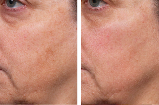 Perméa Laser Treatment Oakland County MI | FACE Beauty Science