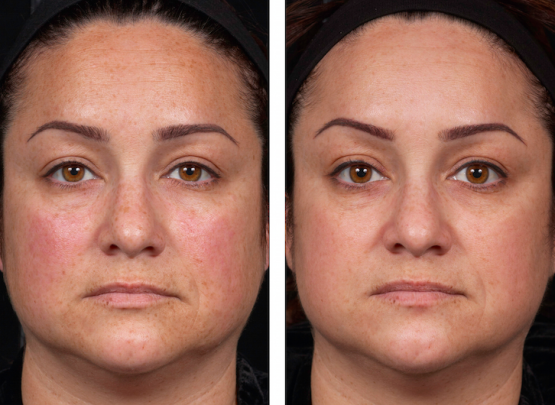 Perméa Laser Treatment Oakland County MI | FACE Beauty Science