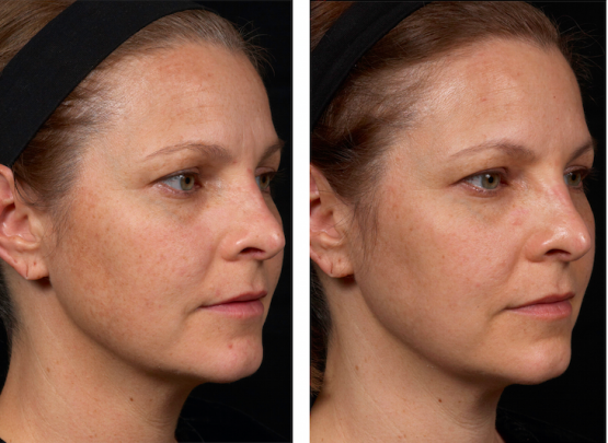 Perméa Laser Treatment Oakland County MI | FACE Beauty Science