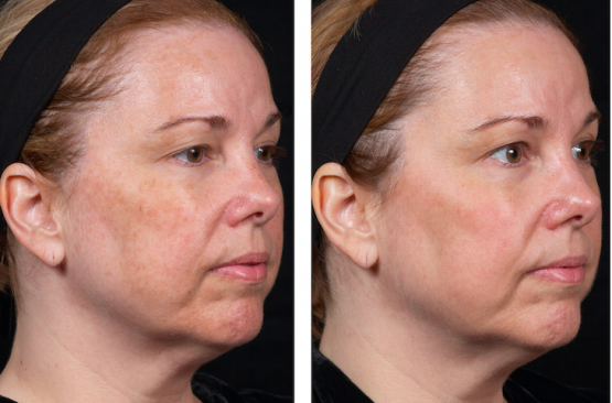 Perméa Laser Treatment Oakland County MI | FACE Beauty Science