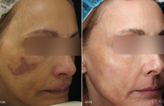 Hyperpigmentation & Melasma Treatments in Oakland County MI | FACE Beauty Science