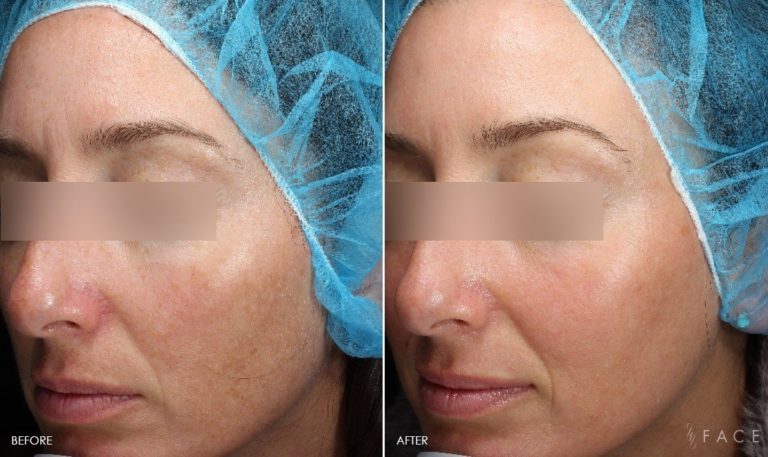 Hyperpigmentation & Melasma Treatments in Oakland County MI | FACE Beauty Science