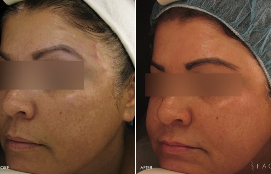 Hyperpigmentation & Melasma Treatments in Oakland County MI | FACE Beauty Science