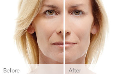 RADIESSE® Treatment Oakland County MI | FACE Beauty Science