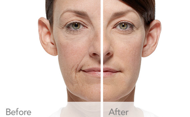 RADIESSE® Treatment Oakland County MI | FACE Beauty Science