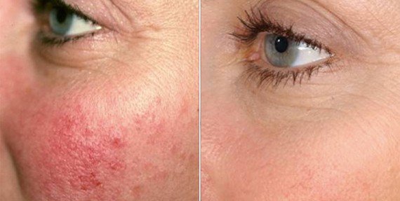 Redness & Rosacea Treatments in Oakland County MI | FACE Beauty Science