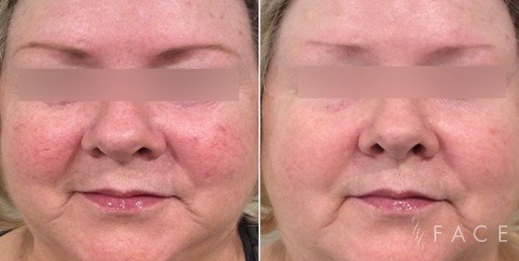 Redness & Rosacea Treatments in Oakland County MI | FACE Beauty Science