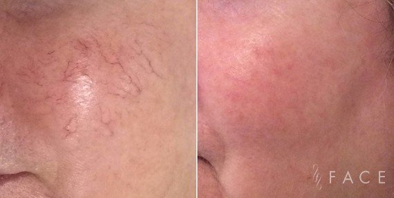 Redness & Rosacea Treatments in Oakland County MI | FACE Beauty Science