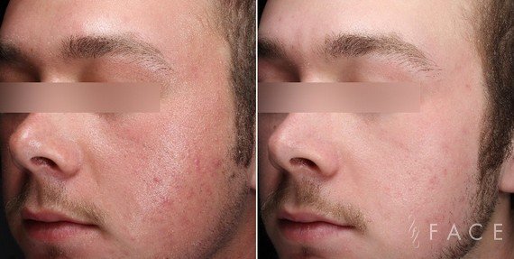 Redness & Rosacea Treatments in Oakland County MI | FACE Beauty Science