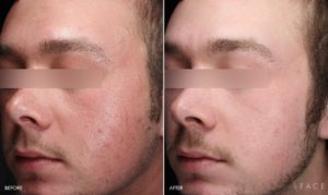 Rosacea Treatment Oakland County MI | FACE Beauty Science