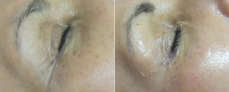 Rezenerate Nano Facial Treatments in Oakland County MI | FACE Beauty Science