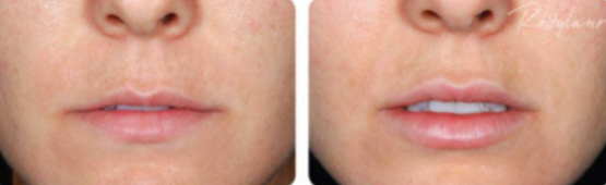 Restylane® Silk Treatments in Oakland County MI | FACE Beauty Science