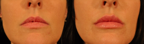 Restylane® Silk Treatments in Oakland County MI | FACE Beauty Science