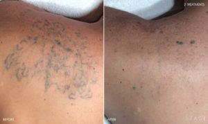 Tattoo Removal Detroit