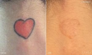 Tattoo Removal Detroit