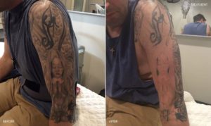 Tattoo Removal Detroit