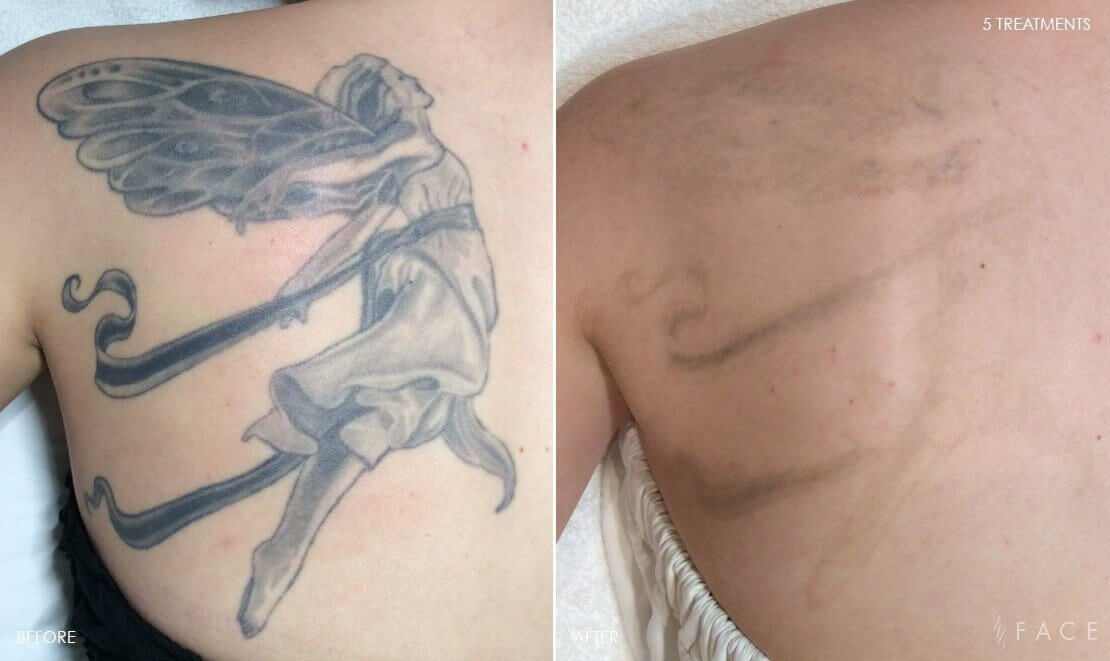 Tattoo Removal Detroit