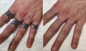 Tattoo Removal Detroit