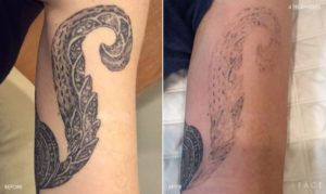 Tattoo Removal Detroit