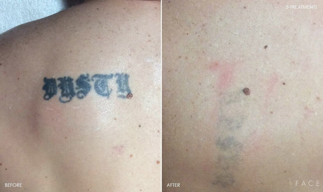 Tattoo Removal Detroit