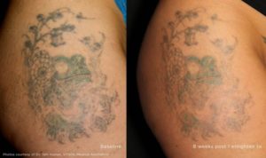 Laser Tattoo Removal in Oakland County MI | FACE Beauty Science