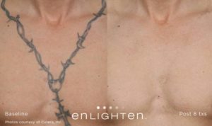 Laser Tattoo Removal in Oakland County MI | FACE Beauty Science