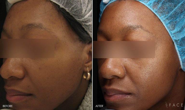 Skin Texture Treatments in Oakland County MI | FACE Beauty Science