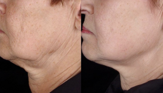 Titan Infrared Skin Tightening Treatments in Oakland County MI | FACE Beauty Science