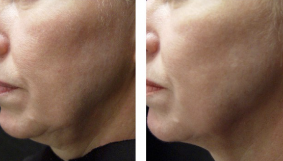 Titan Infrared Skin Tightening Treatments in Oakland County MI | FACE Beauty Science