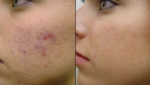 Stem Cell Facial and Oxy Plasma Facial Michigan