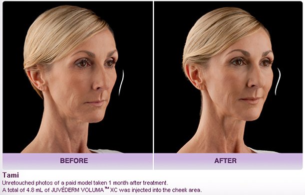 JUVÉDERM VOLUMA® XC Injectable Filler in Oakland County MI | FACE Beauty Science