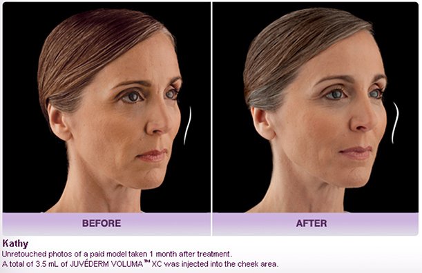 JUVÉDERM VOLUMA® XC Injectable Filler in Oakland County MI | FACE Beauty Science