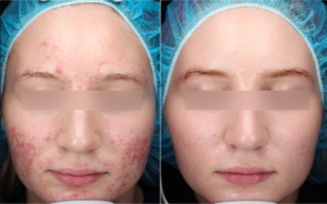 Pearl Fractional Treatments in Oakland County MI | FACE Beauty Science