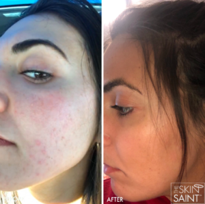 Acne Treatments in Oakland County MI | FACE Beauty Science