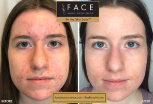 Cystic Acne Treatments in Oakland County MI | FACE Beauty Science