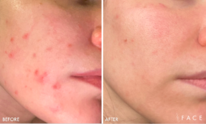 Acne Treatments in Oakland County MI | FACE Beauty Science