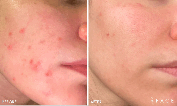 Face Photo Gallery - Acne | Face Beauty Science