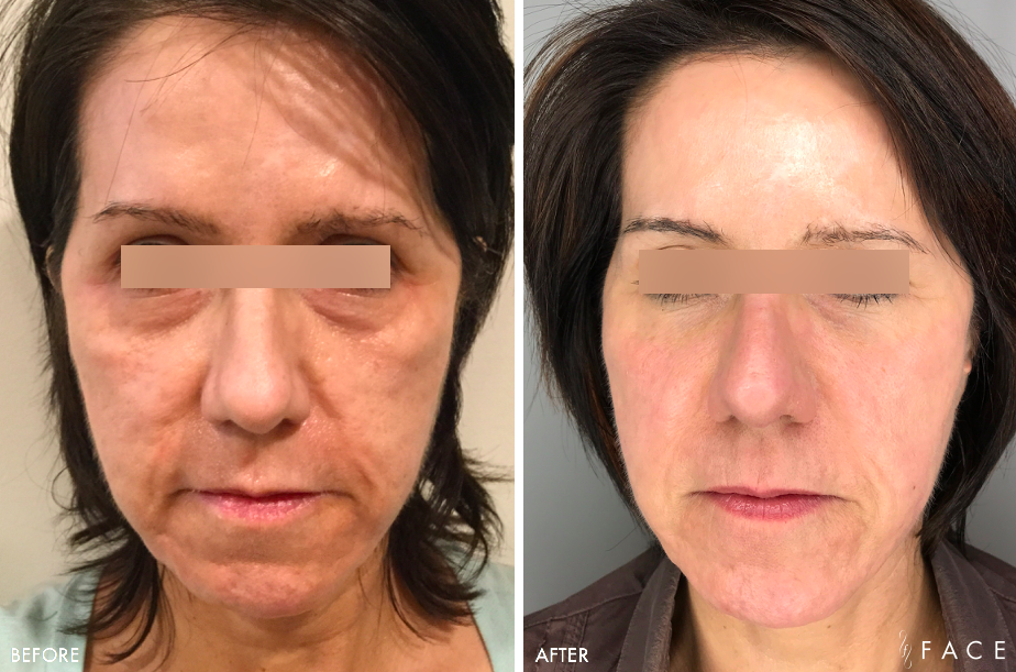 Anti-Aging Results Oakland County MI | FACE Beauty Science