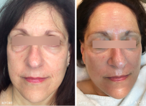 Anti-Aging Results Oakland County MI | FACE Beauty Science