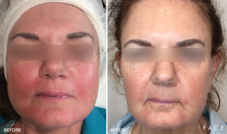 excel® V CoolView Laser Treatments in Oakland County MI | FACE Beauty Science