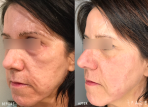 Anti-Aging Results Oakland County MI | FACE Beauty Science