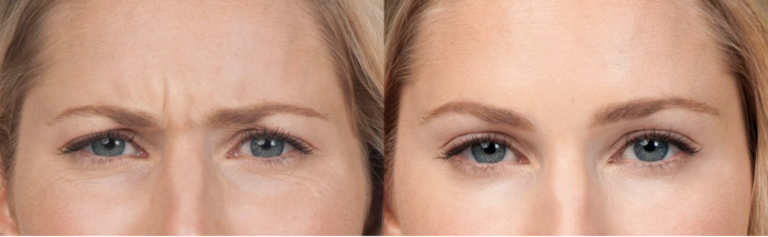 Jeuveau™ Injectable Fillers Oakland County MI | FACE Beauty Science