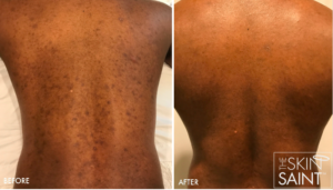 Hyperpigmentation & Melasma Treatments in Oakland County MI | FACE Beauty Science