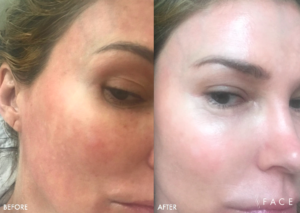 Hyperpigmentation & Melasma Treatments in Oakland County MI | FACE Beauty Science