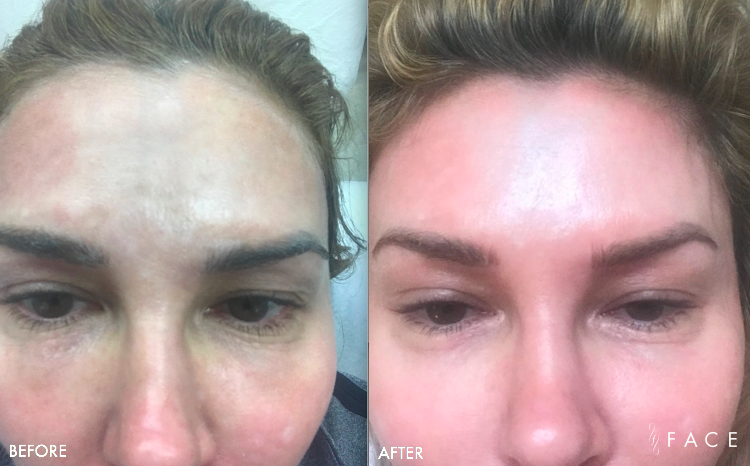 Hyperpigmentation & Melasma Treatments in Oakland County MI | FACE Beauty Science