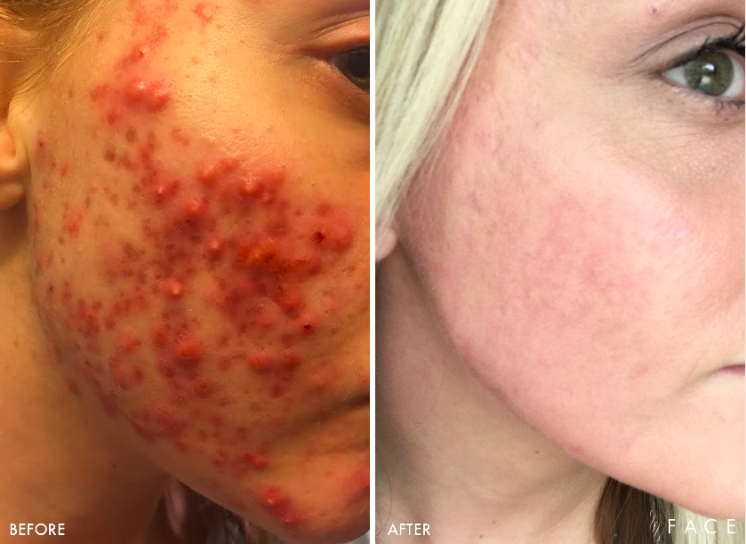 Cystic Acne Treatments in Oakland County MI | FACE Beauty Science
