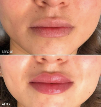 Restylane® Kysse Injectable Fillers Oakland County MI | FACE Beauty Science