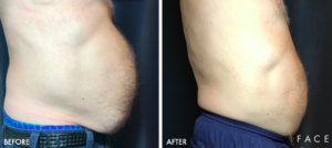 EMSCULPT® Treatments in Oakland County MI | FACE Beauty Science